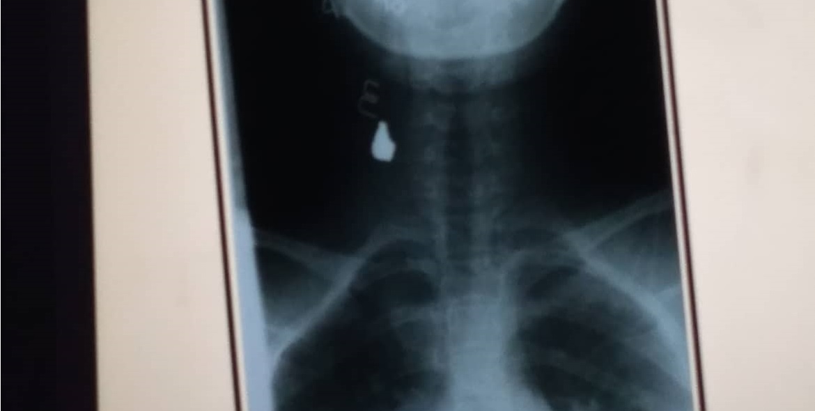 Kopya ng XRay result kung saan makikita ang lokasyon ng pumasok na bala sa may leeg ng biktima